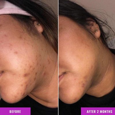 Alcohol Free Skin Molecules Discoloration Correcting Serum Tranexamic Acid Niacinamide For Dark Age Spots