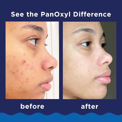 Antimicrobial Benzoyl Peroxide Acne Foaming Wash Facial Cleanser Unscented