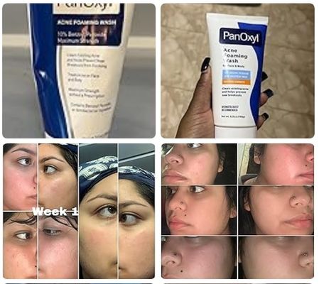 Antimicrobial Benzoyl Peroxide Acne Foaming Wash Facial Cleanser Unscented